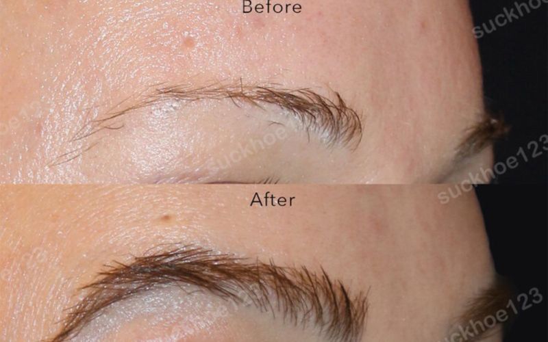 Cấy lông mày chữ nhất