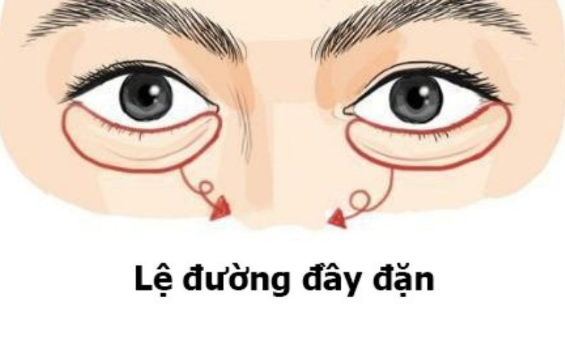 Lệ đường dưới mắt là vùng ngay dưới bọng mắt, phản ánh cảm xúc, tình duyên