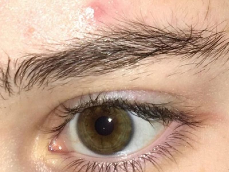 Nguyên nhân dẫn đến tình trạng dựng ngược lông mày 